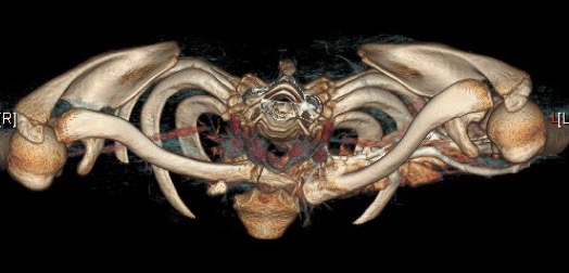 Posterior SCJ Dislocation CT